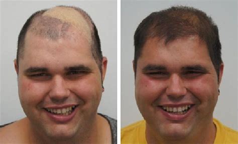 Haartransplantatie: Een Jaar Later – Wat Is Er Veranderd?